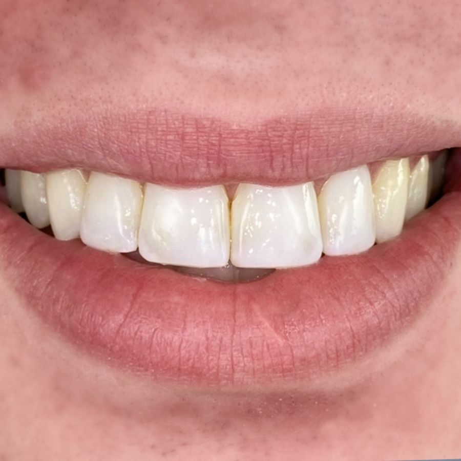 composite bonding - smile 5 - before - 3Dental
